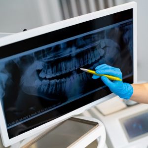 Radiografías dentales en Las Palmas